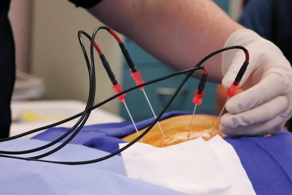 Abstract background representing targeted nerve pain relief through radiofrequency ablation