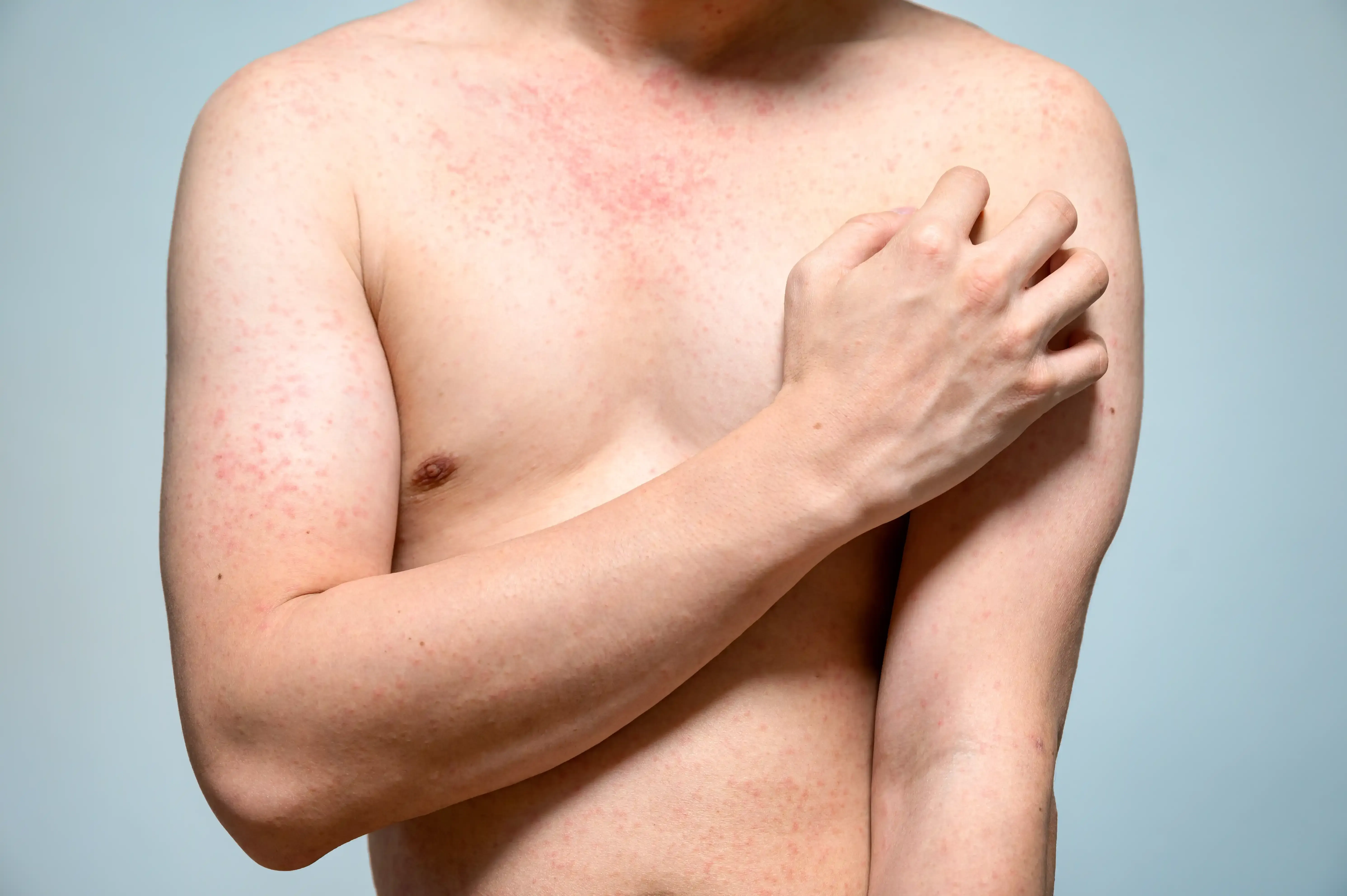 Risk factors for post-herpetic neuralgia at Pain Treatment Center of Maryland Reisterstown