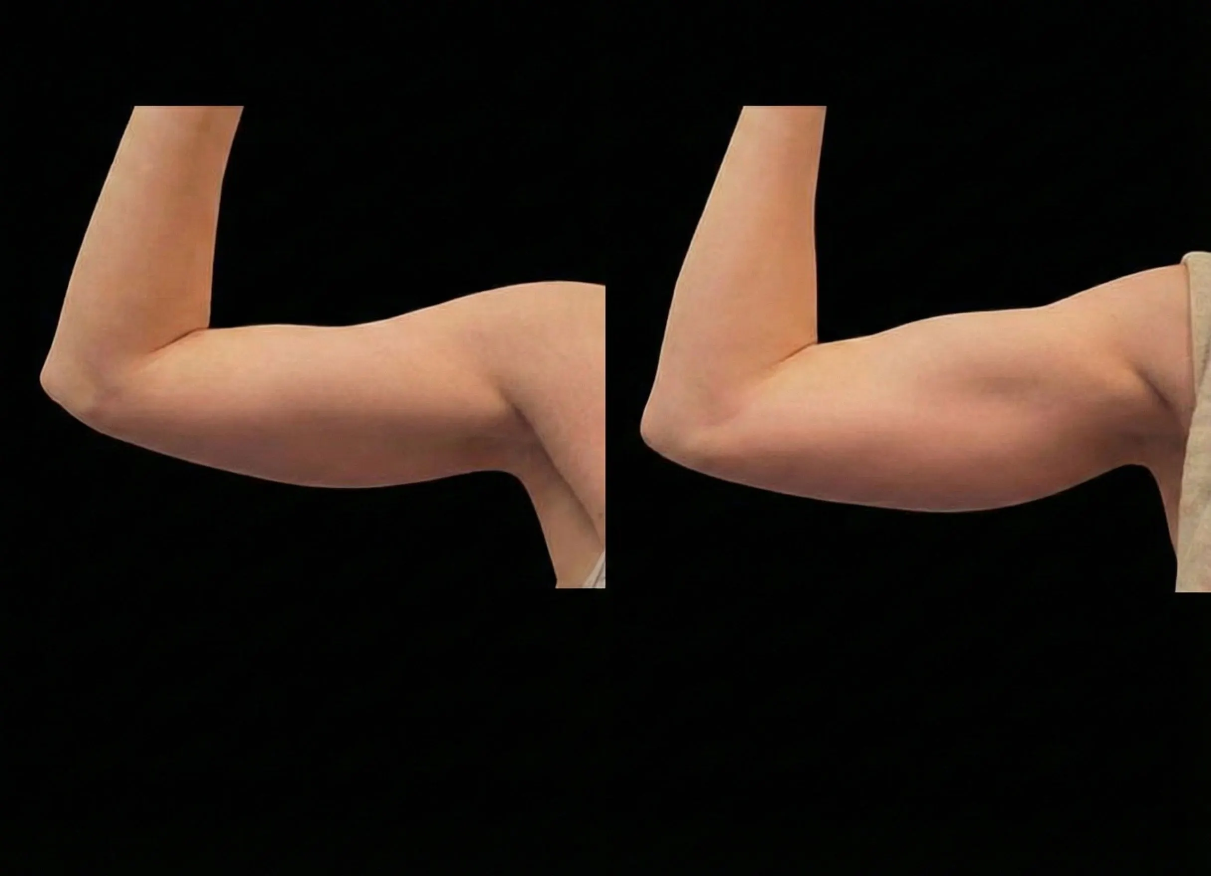 Emsculpt Neo  - Before and After