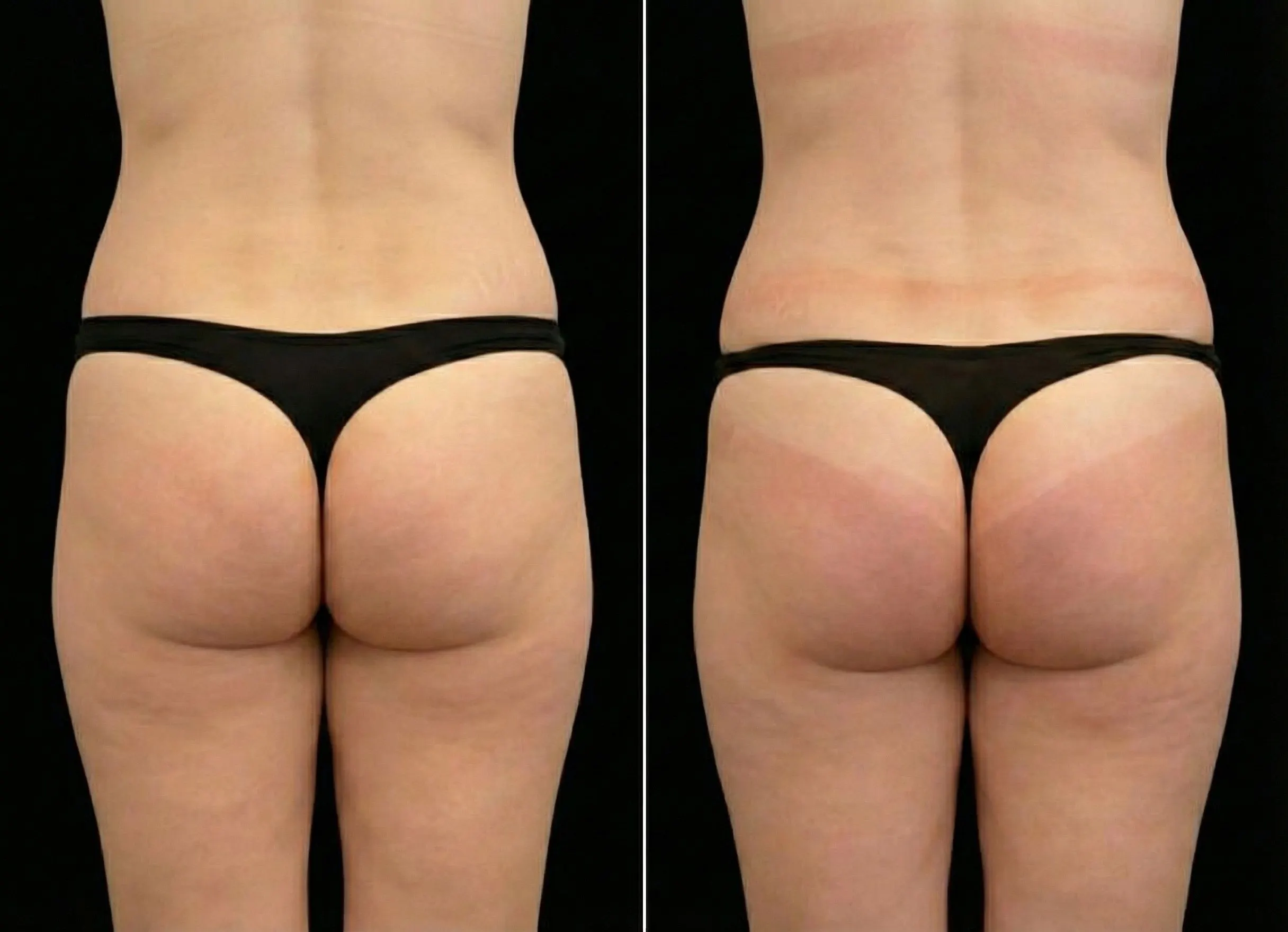 Emsculpt Neo  - Before and After