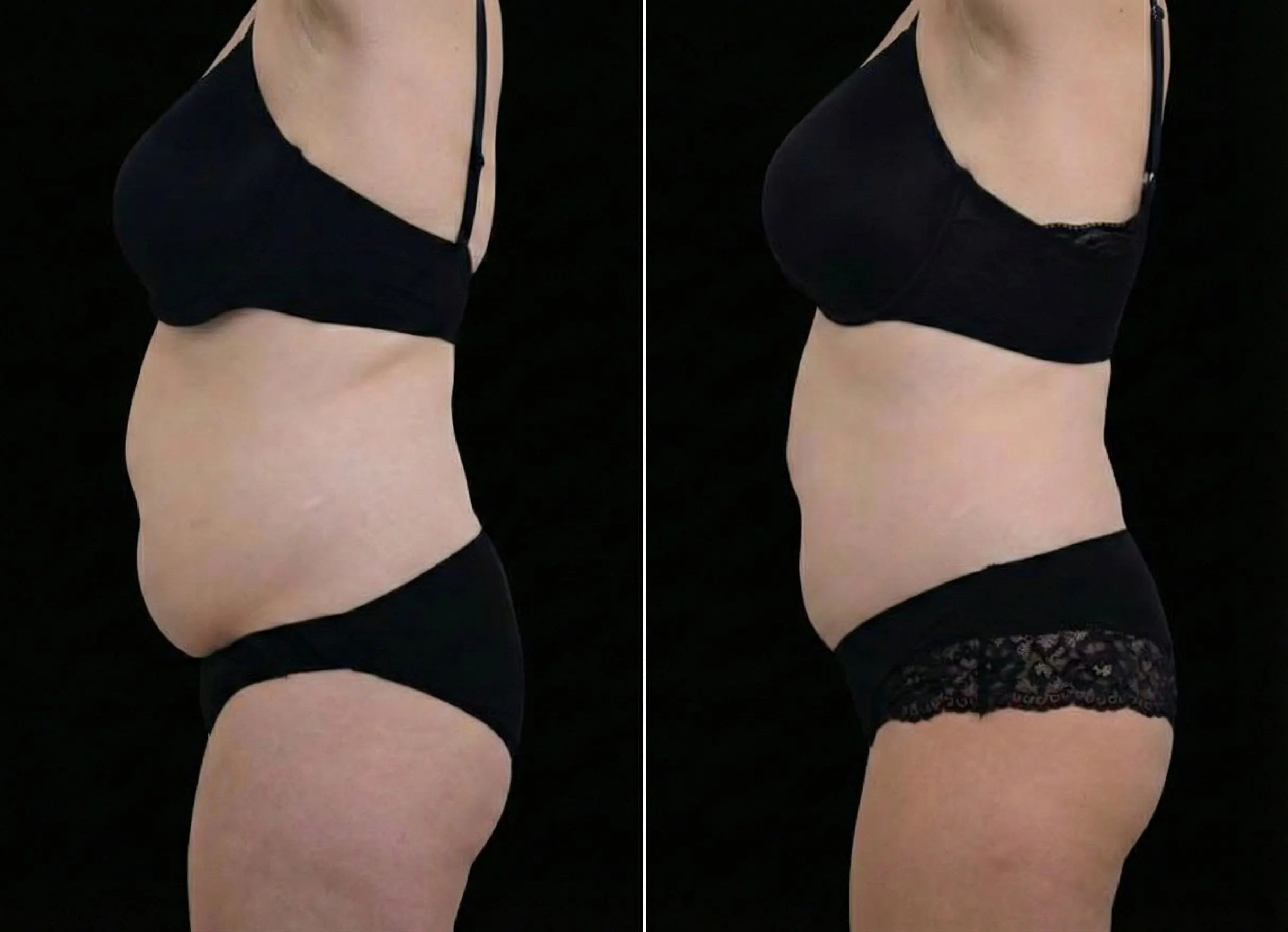 Emsculpt Neo  - Before and After